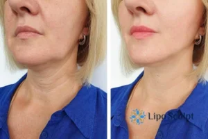 Double chin before and after Hi-Fu treatment 4 Book your double chin treatment Croxton today! We are here to help!