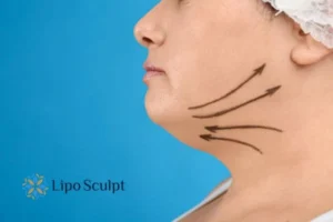 Double chin before and after Hi-Fu treatment 3 Boost your confidence with a Double chin treatment Croxton