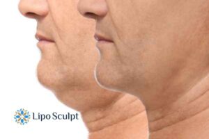 Double chin before and after Hi-Fu treatment 2 Double chin treatment Croxton from Lipo Sculpt - feel more confident today!