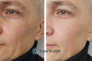 How to Fight Aging Symptoms 3 Fight Aging Symptoms Croxton With HIFU and Morpheus8 Today!