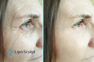 How to Fight Aging Symptoms 2 Do you want to Fight Aging Symptoms Croxton? Contact Lipo Sculpt today!