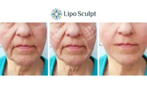 Explaining Morpheus8 And What It Can Do For You 3 Boost your confidence with Morpheus8 Croxton call our team today!